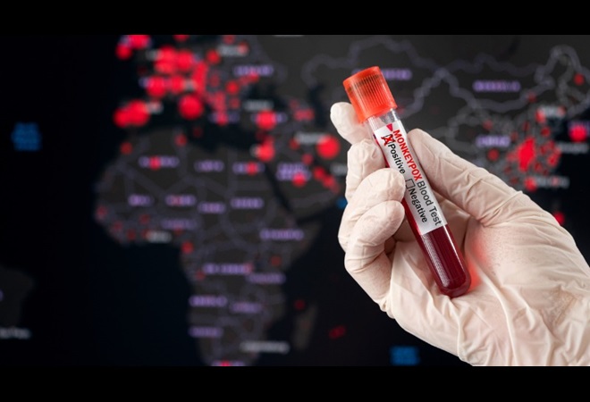 labo onderzoekt besmetting Mpox-virus